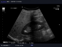 Ultrazvok ledvic - ledvični kamen v čašicah (kaliksu) zgornje in spodnje skupine